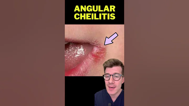 5 skin and nail signs of IRON DEFICIENCY ANAEMIA #shorts