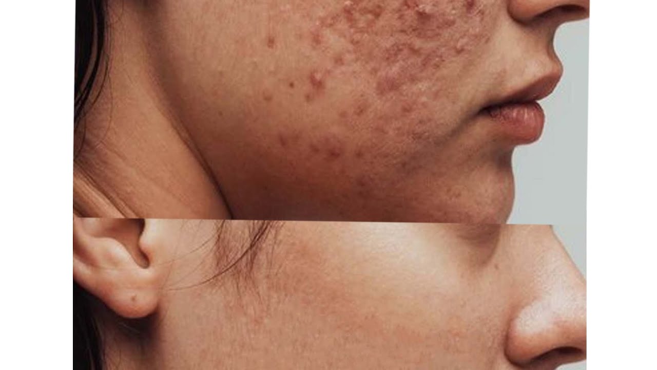 মুখের বরণ রিমুভ করা । Dark Spot remove In 1 munite in PhotoShop 2025 