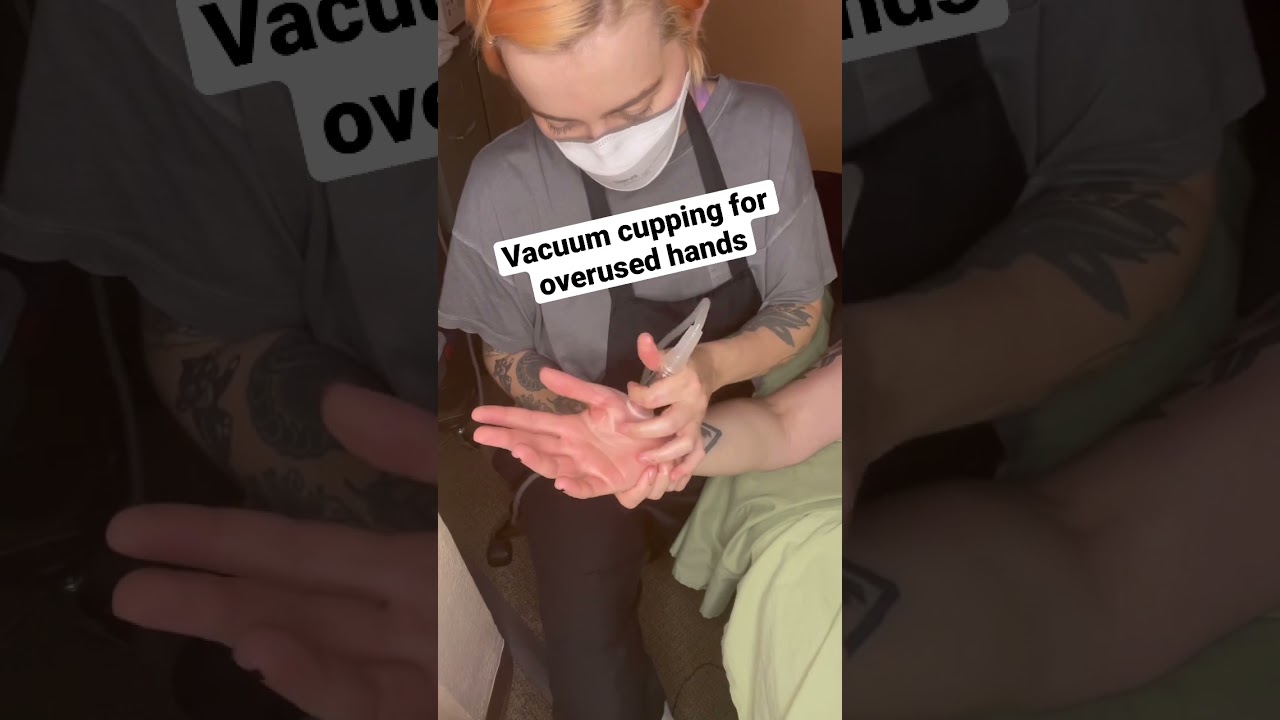 Cupping Therapy For Hand Overuse Pain Relief 