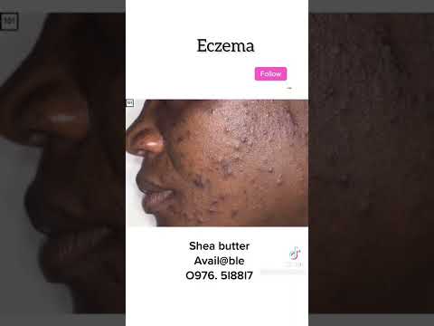 Video: Veroorzaakt sheaboter acne?