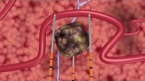 Irreversible electroporation (IRE) with the NanoKnife for the treatment of prostate cancer