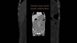 Closed loop small bowel obstruction