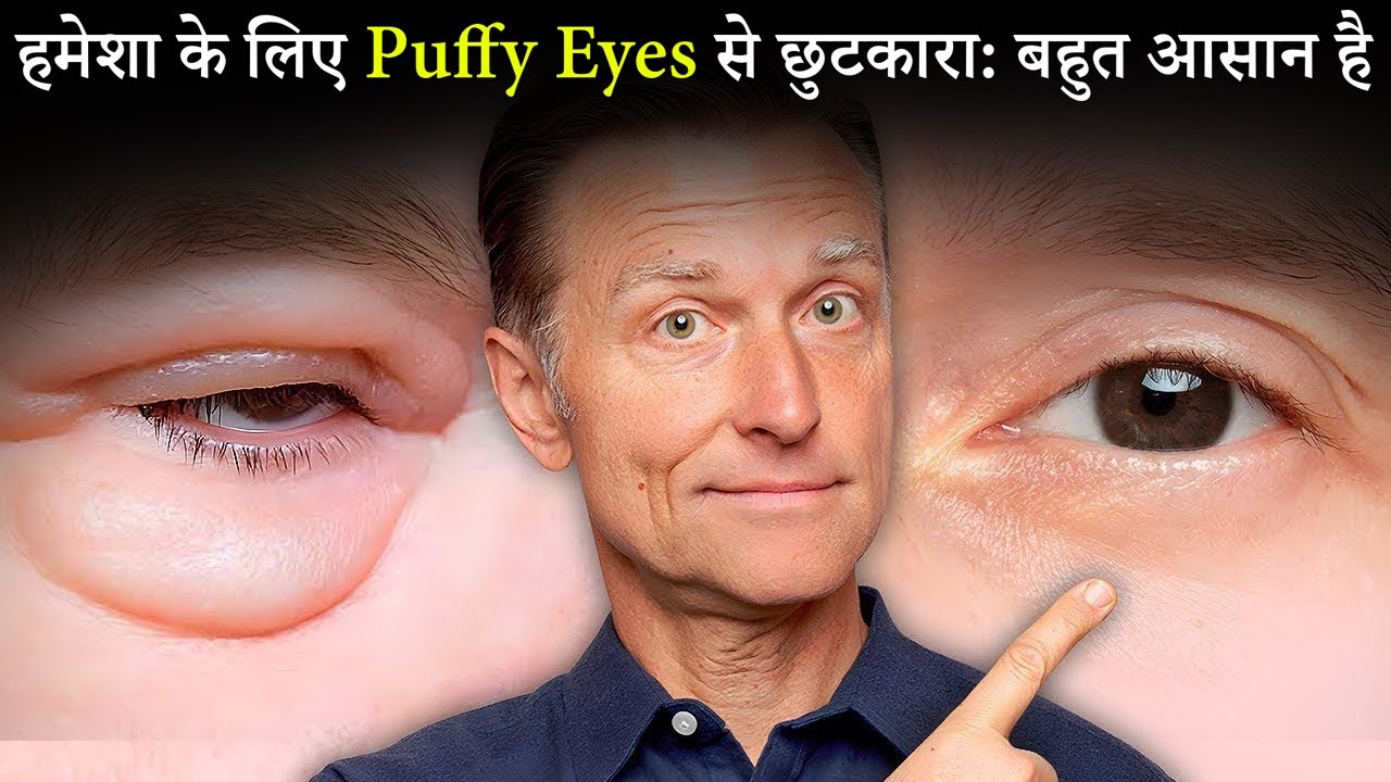 आँखों की सूजन (Puffy Eyes) से छुटकारा पाएँ Dr. Eric Berg Hindi Sub