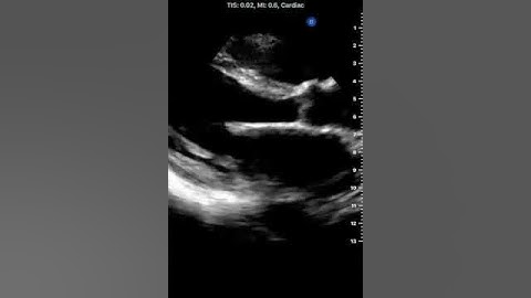 Cardiac Mitral Valve Prolapse via Parasternal Long Axis: Captured with Butterfly iQ™