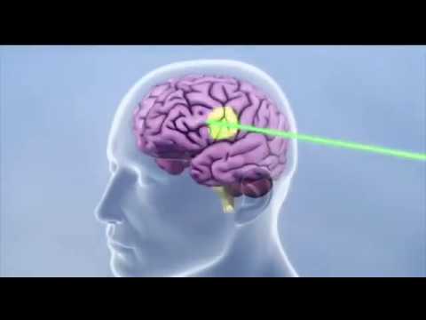 قرارگیری شتابدهنده خطی بر روی خط پزشکی ایران