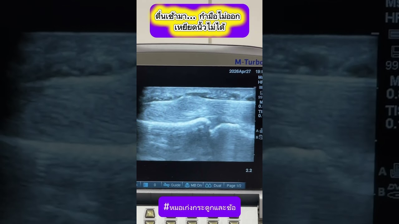 ตื่นเช้ามา ... กำมือไม่ออก เหยียดนิ้วไม่ได้