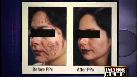 Ivanhoe News: Dr. Dale Isaacson on Acne