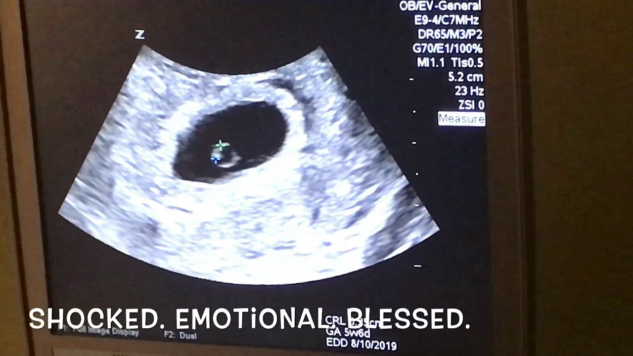 6 Weeks 4 Days Twins Ultrasound