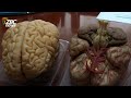 Zimbabwe Expands Brain Tumour Care as Doctors Warn Against Delayed Treatment