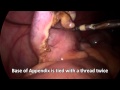 Laparoscopic appendicectomy  patient education  punjab  india  dr jasmeet singh ahluwalia