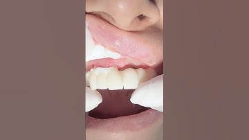 Zirconia bridge on root canal treated teeth to replace missing teeth #toothless