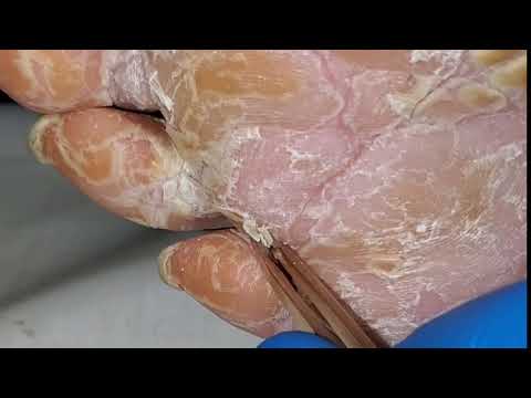 Vídeo: Peeling Feet: Remedios Increíbles