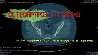Деформирующий ОСТЕОАРТРОЗ тазобедренного сустава 2 степени и ИМПИДЖМЕНТ СИНДРОМ на РАСШИФРОВКЕ КТ
