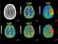 Introduction to CT perfusion before Call.