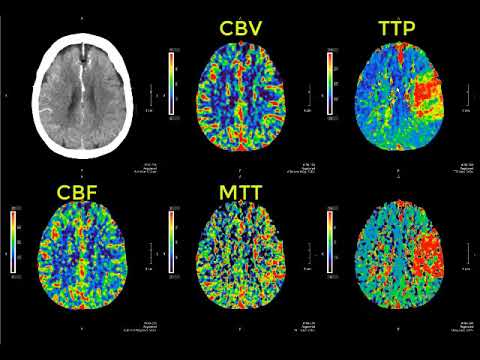 Introduction to CT perfusion before Call.