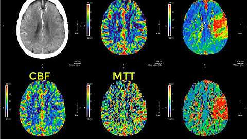 Introduction to CT perfusion before Call.