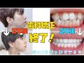 【歯科矯正】終わりました!整形するより顔変わった。【2年間全部見せます】
