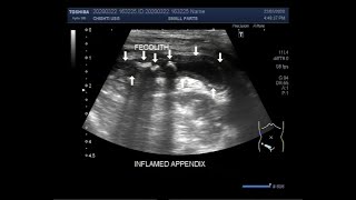 Ultrasound Video Showing Acute Appendicitis And Differential Diagnosis.