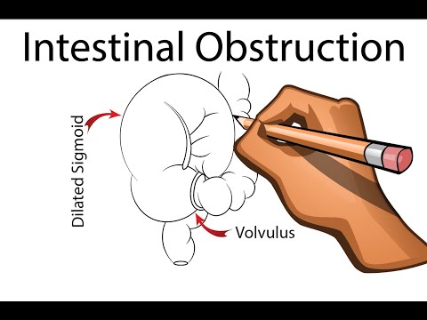 Intestinal Obstruction -  Part 1