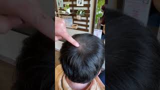 薄毛のオデコがスーパーミリオンヘアーのファンデーションを使ってみたら… #shorts #薄毛 #スーパーミリオンヘアー #白髪