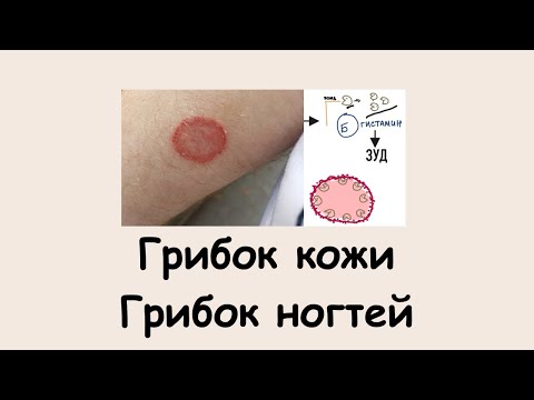 Грибок кожи. Грибок ногтей. #грибоккожи#грибокногтей#подготовкакusmle