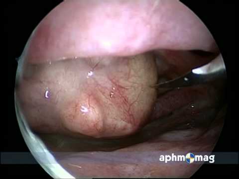 Chirurgie vidéo-endoscopique des sinus : AP-HM mag flash