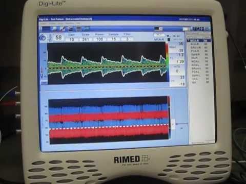 Transcranial doppler - TCD - Rimed
