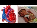 Ventricular Septal Defect VSD DALOOLKA WADNAHA Ventricular Septal Defect VSD DALOOLKA WADNAHA