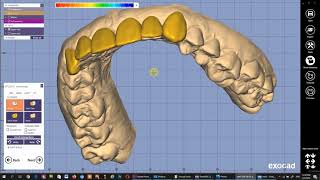 تخطيط  الابتسامة و تحضير التجربة بالطباعة 3D