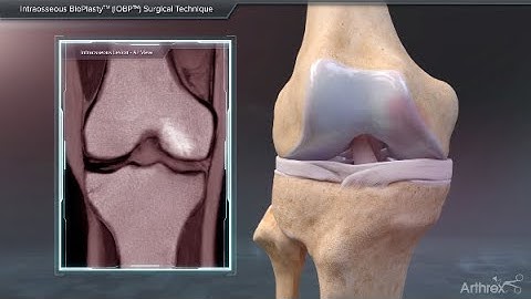 Intraosseous BioPlasty™ (IOBP) Surgical Technique