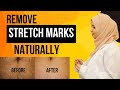 How to Get Rid of Stretch Marks Naturally | 1 Remedy for Stretch Marks Removal | Dr. Tahera Khaledi