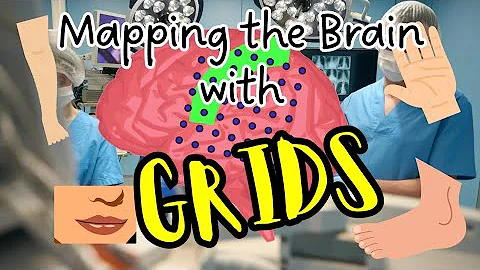 Mapping the Brain with GRIDS Electrodes and Homunculus