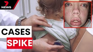 Massive spike in pneumonia cases in SA children | 7 News Australia