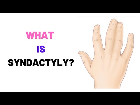 WHAT IS SYNDACTYLY? - WEBBED FINGERS, Causes, Symptoms, Treatment, Surgery