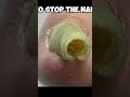 Watch How Dr Nick Fixes This Toenail Amazing 