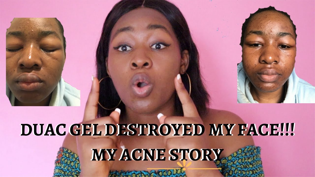 DUAC GEL DESTROYED MY FACE MY ACNE STORY SKINCARE YouTube