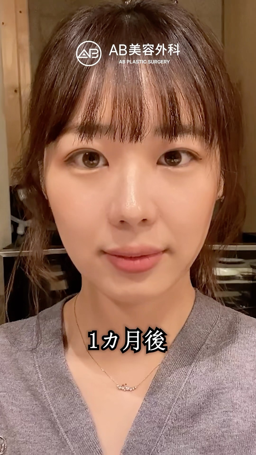 自然癒着整形 直後 vs 1ヶ月後…こんなに変わる？#shorts