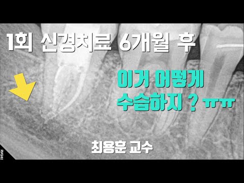 C-shape 근관의 1회 신경치료, 그 결과는 ?