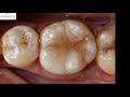 3. Avoid root canal