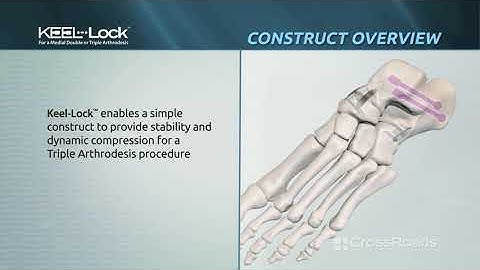 Keel-Lock™ Nitinol Implant System Animation