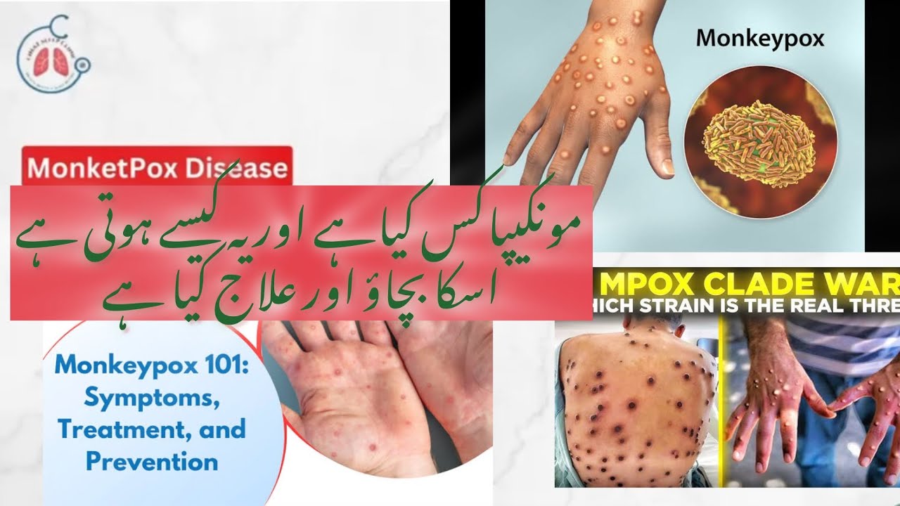 Monkey Pox Disease | causes | Symptoms | Prevention | Treatment | Dr Rashid Daudpota