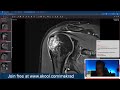 Shoulder MRI Focus Sessions - LIVE