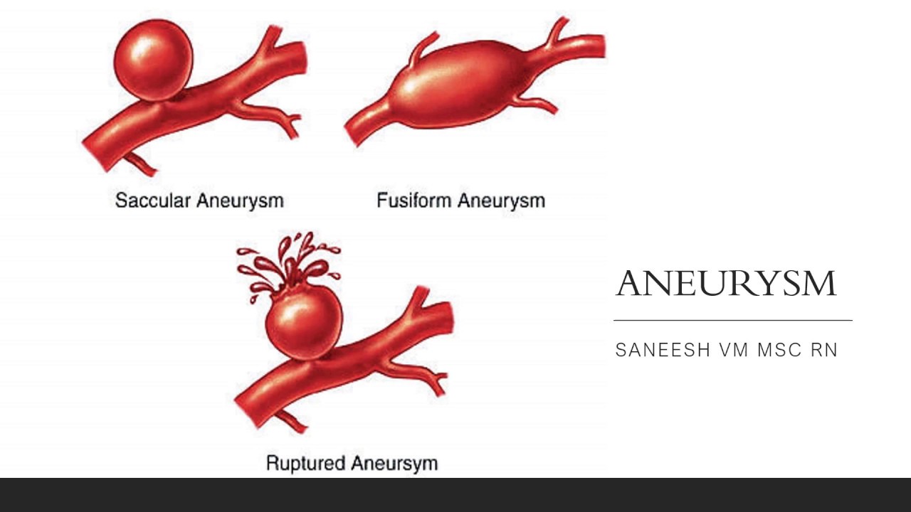 Симптомы разрыва аневризмы. Веретенообразная аневризма. Мешотчатая аневризма сосудов. Фузиформное расширение аневризма.