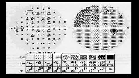 6- Visual field interpretation (Gray Scale in Humphrey perimeter).