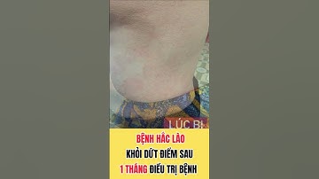 #45. BỆNH HẮC LÀO khỏi dứt điểm sau 1 tháng điều trị bệnh #shorts #haclao