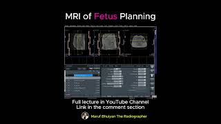 MRI of Fetus / Pregnant woman abdomen #mri #radiology #medicalimaging #radiographer #radiography