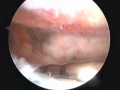 Arthroscopic Acromioclavicular Joint Excision Dr  Terry Hammond