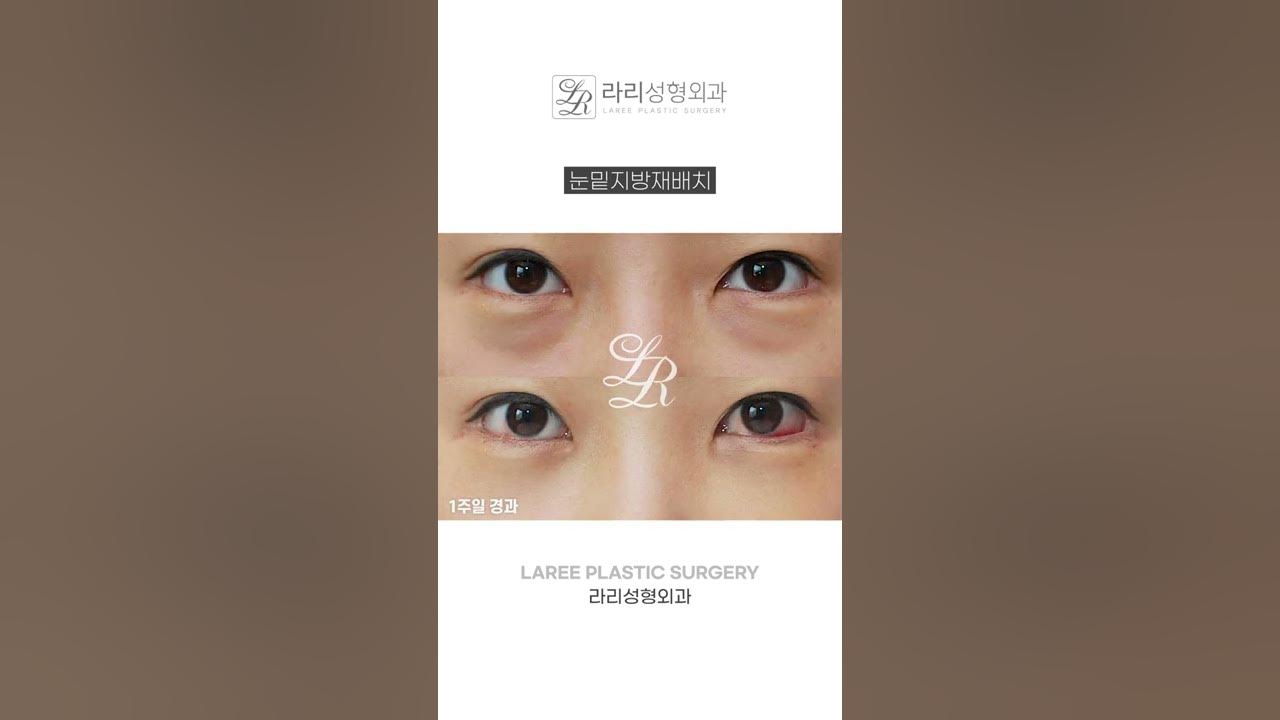 눈밑지방재배치 | 라리성형외과 #Shorts - Youtube