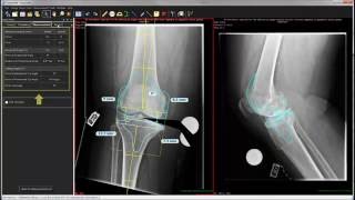 Auto-Knee Planning with TraumaCad