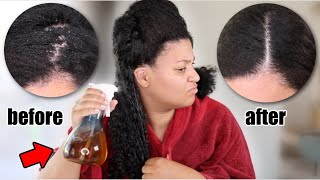 Get rid of EXTREME dandruff & itchy scalp on natural hair doing THIS! *crazy results* 😱